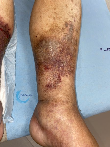 Fichier:Dermiteocre90.jpg