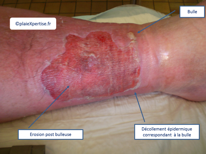 Fichier:Erosions post bulleuses1.png