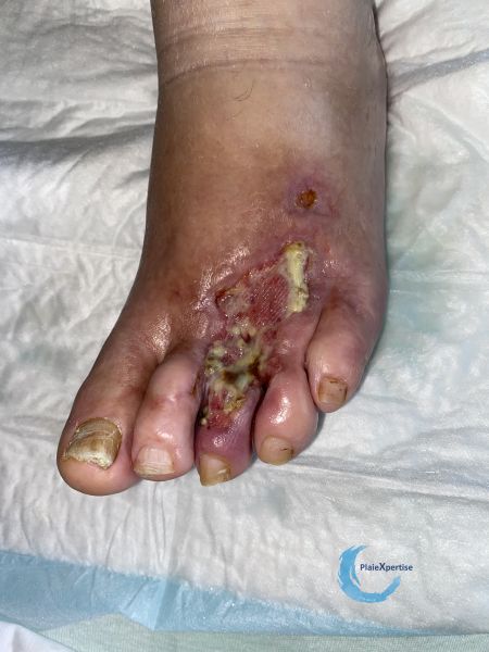 Fichier:Pied infecté32.jpg