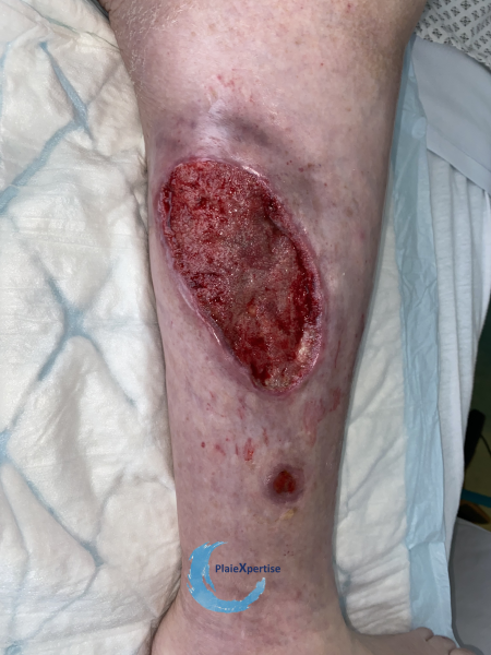Fichier:Tissu de granulation inflammatoire36.png