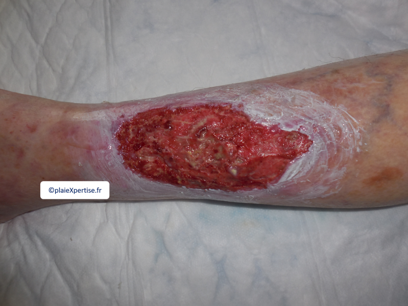 Fichier:Tissu de granulation inflammatoire7.png