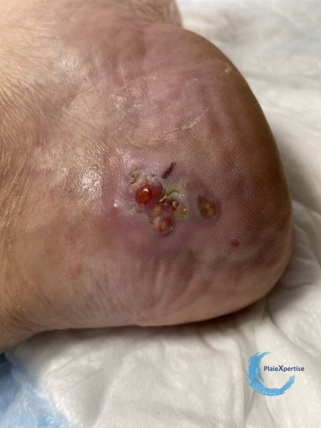Fichier:Calcifications41.jpg