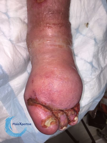 Fichier:Lymphoedème72.jpg