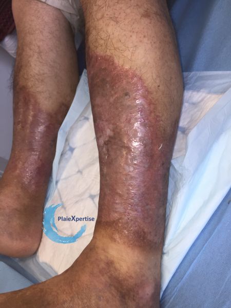 Fichier:Nécrobiose lipoïdique18.jpg