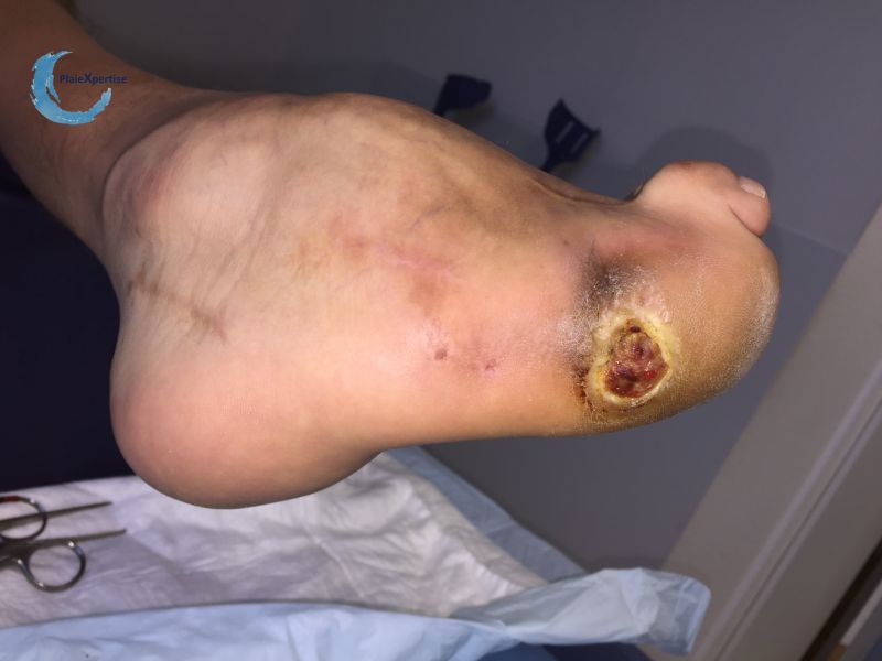 Fichier:Pied de Charcot15.jpg