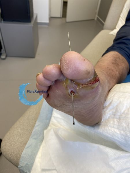 Fichier:Plaies transfixiantes5.jpg