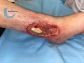 Tendon nécrotique humide55.jpg