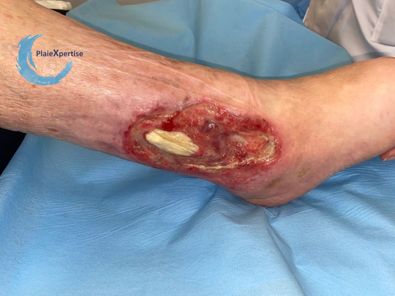 Fichier:Tendon nécrotique humide55.jpg