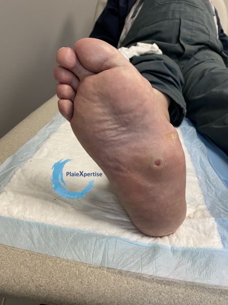 Fichier:Pied de Charcot19.jpg