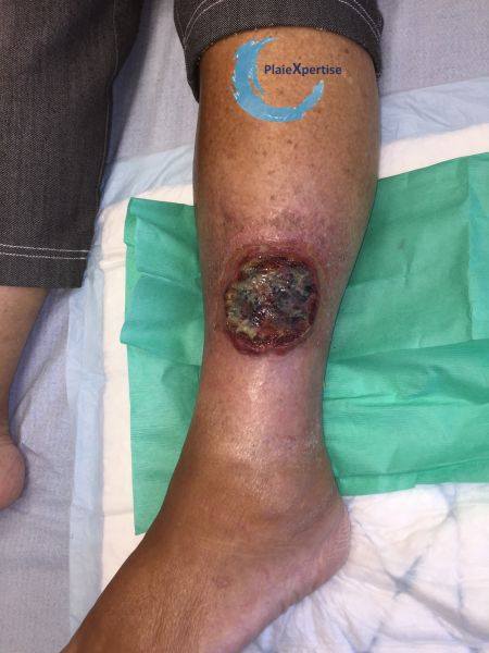 Fichier:Pyoderma gangrenosum32.jpg