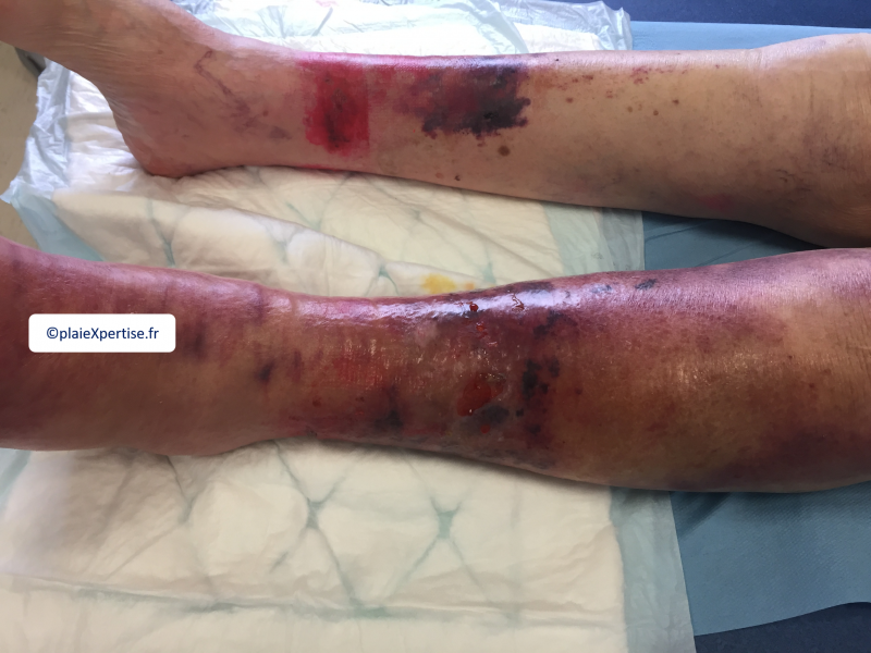 Fichier:Dermatoporose4.png