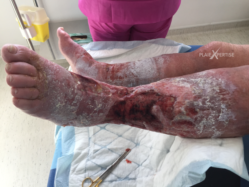 Fichier:Grosses jambes suintantes22.png