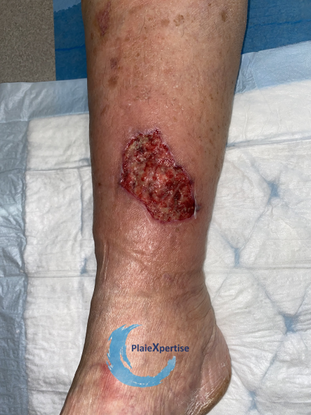 Fichier:Tissu de granulation inflammatoire33.png