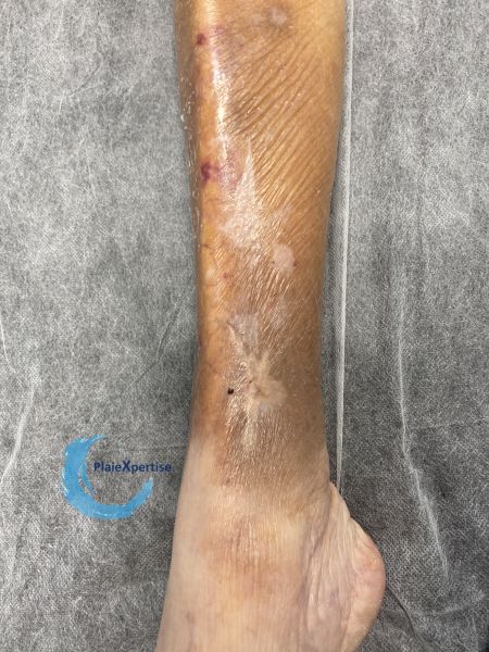 Fichier:Dermatoporose37.jpg