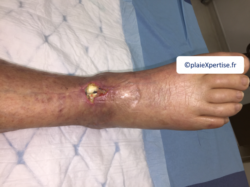 Fichier:Cou de pied10.png