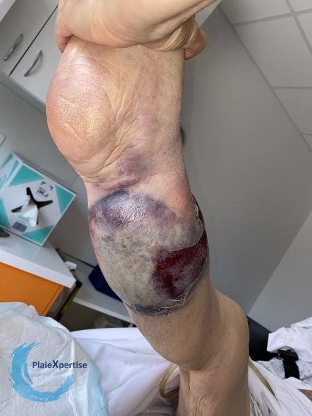 Fichier:Hématome disséquant ouvert41.jpg