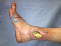 Tendon nécrotique humide53.jpg
