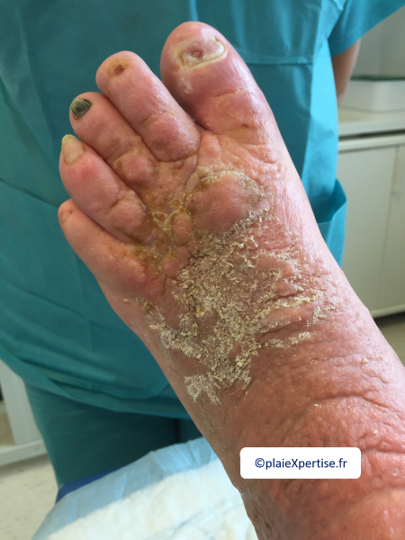 Fichier:Lymphoedème pied7.png