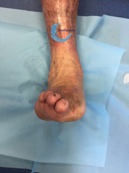 Fichier:Pied déformé11.jpg