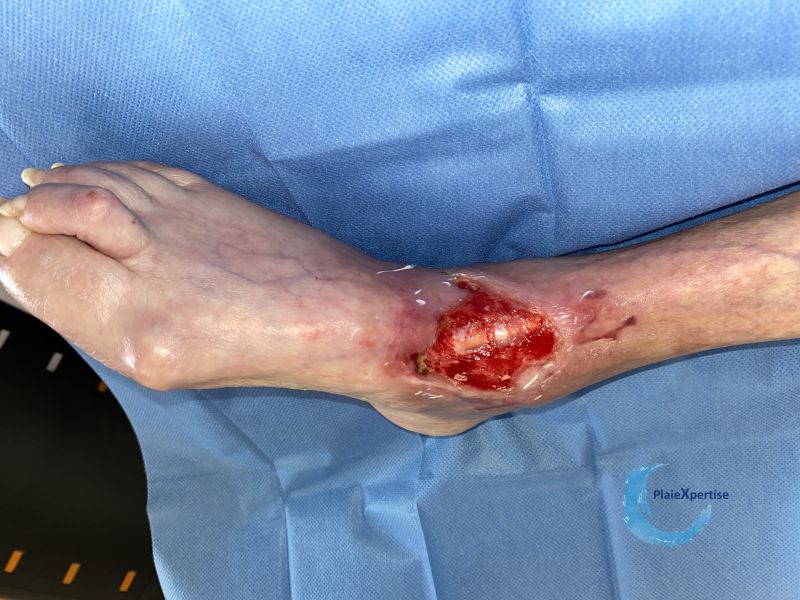 Fichier:Cou de pied78.jpg