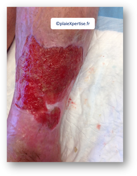 Fichier:Tissu de granulation normal5.png