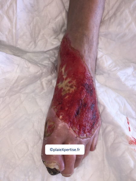Fichier:Cou de pied7.png