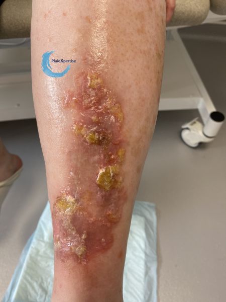 Fichier:Eczéma164.jpg