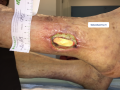 Tendon normal2.png