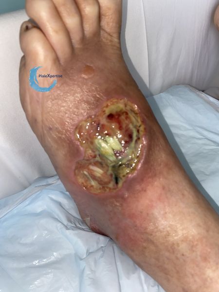 Fichier:Cou de pied100.jpg