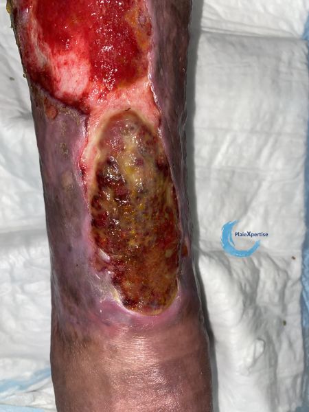 Fichier:Tissu de granulation inflammatoire57.jpg
