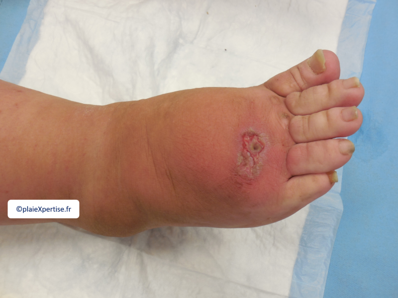 Fichier:Lymphoedème pied9.png