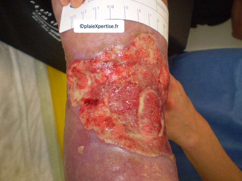Fichier:Tendon-Voussure7.png