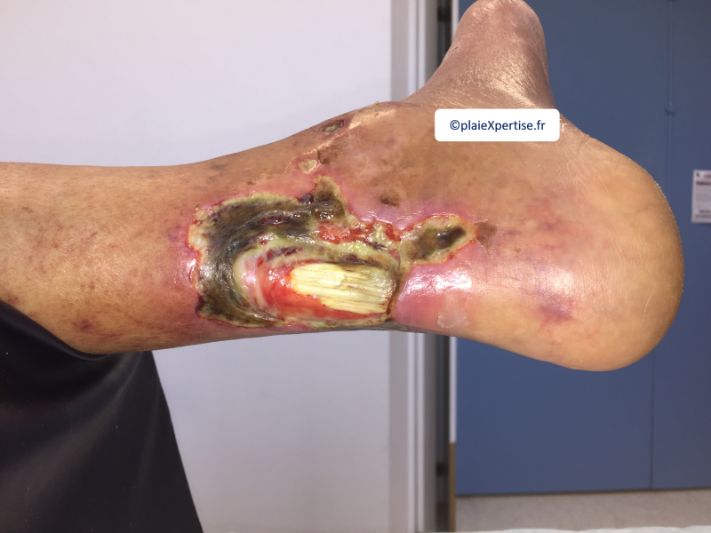 Fichier:Tendon nécrotique humide21.png