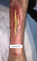 Tendon nécrotique humide30.png