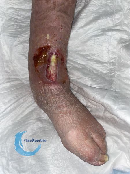 Fichier:Cou de pied71.jpg