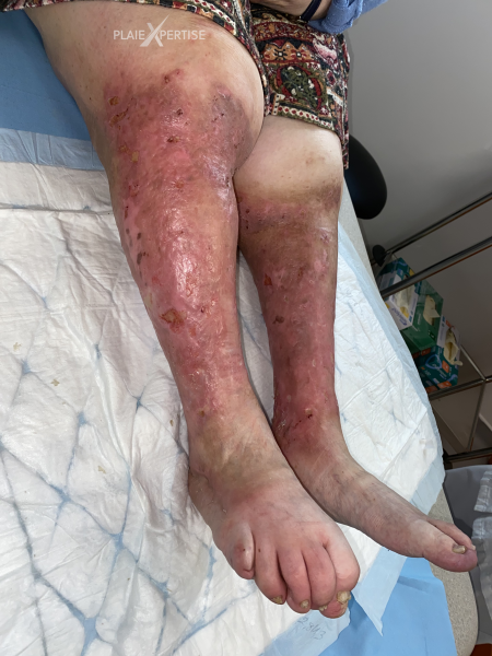 Fichier:Hypodermite chronique37.png