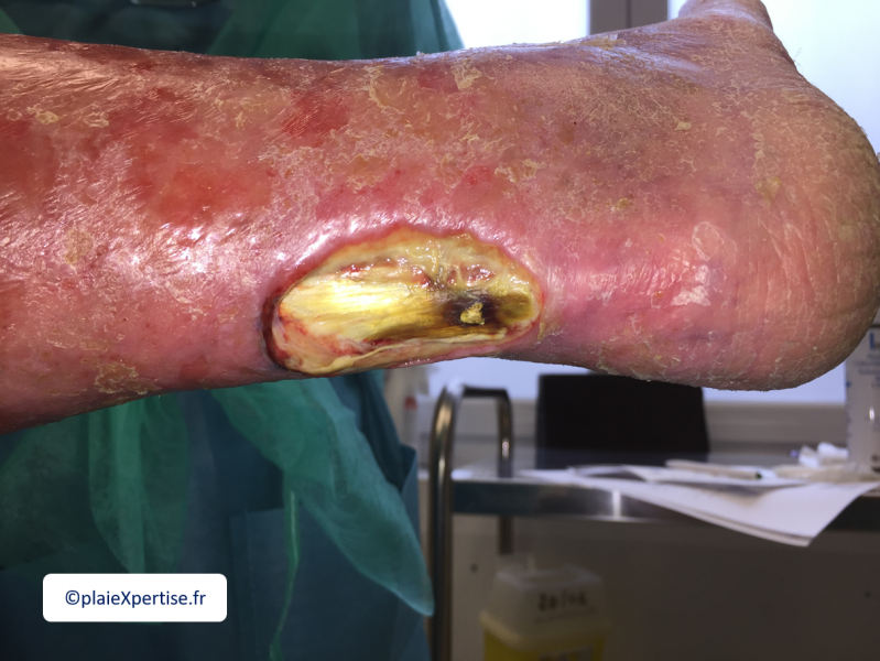 Fichier:Tendon nécrotique sec5.png