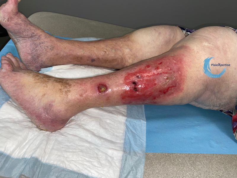 Fichier:Calcifications46.jpg