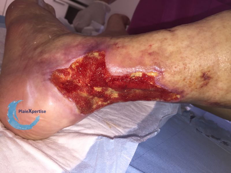 Fichier:Tendon-Reliquat23.jpg