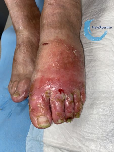 Fichier:Eczéma105.jpg