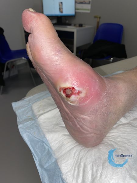 Fichier:Pied de Charcot38.jpg