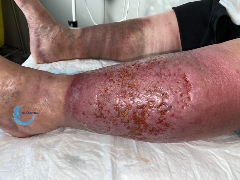 Fichier:Grosses jambes suintantes38.jpg