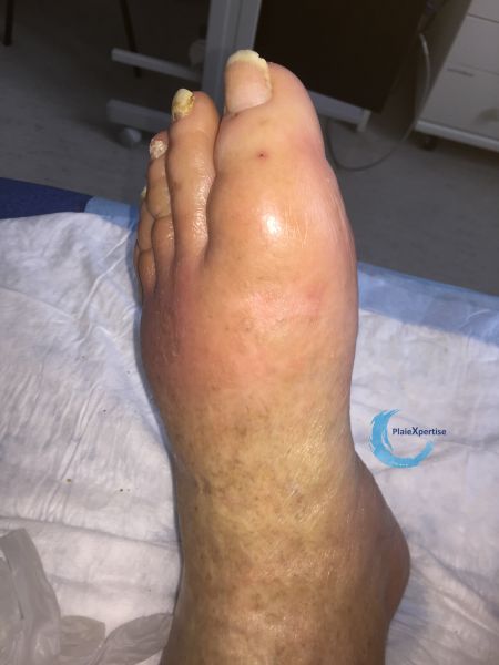 Fichier:Pied goutteux5.jpg
