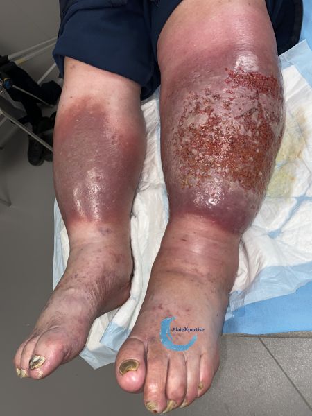 Fichier:Grosses jambes suintantes37.jpg