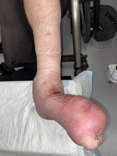 Fichier:Lymphoedème pied20.png