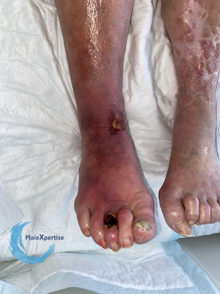 Fichier:Erythrocyanose20.jpg