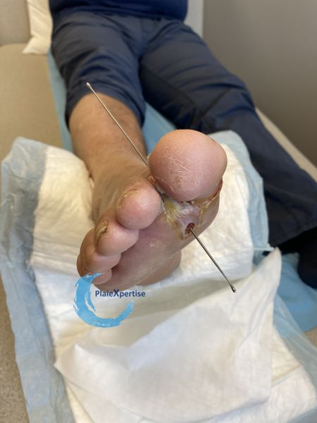 Fichier:Plaies transfixiantes4.jpg