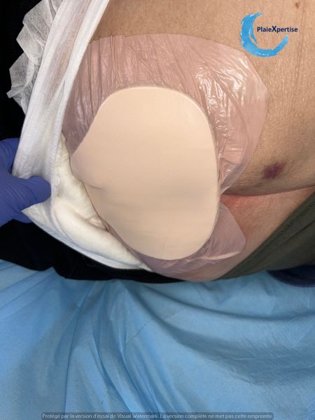 Fichier:Dermite d'irritation203.jpg