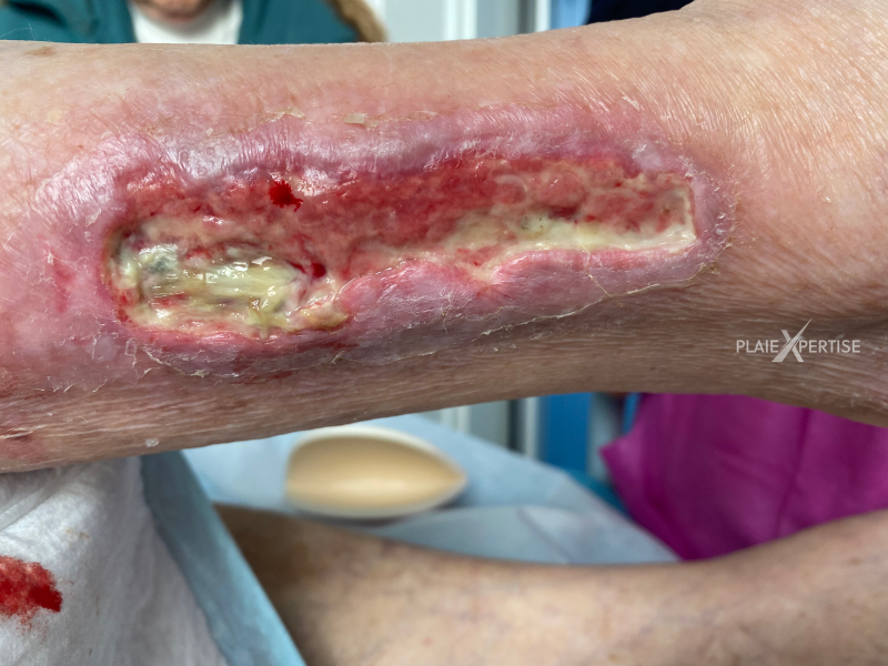 Fichier:Tendon-Reliquat9.png
