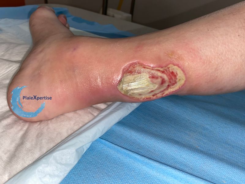 Fichier:Tendon normal29.jpg